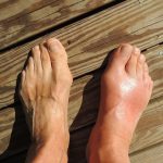 5 Buah Ampuh Turunkan Asam Urat Tinggi Secara Alami