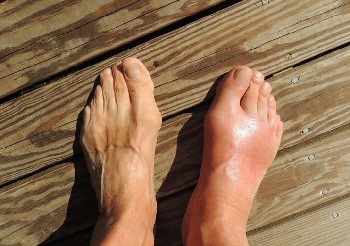 5 Buah Ampuh Turunkan Asam Urat Tinggi Secara Alami